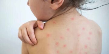 Alerta por sarampión y nueva variante de dengue en Tamaulipas