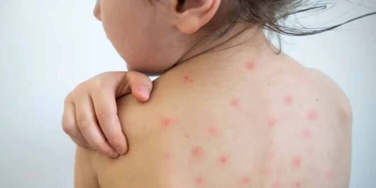 Alerta por sarampión y nueva variante de dengue en Tamaulipas