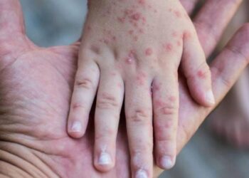 Reportan 7 casos confirmados de sarampión en México