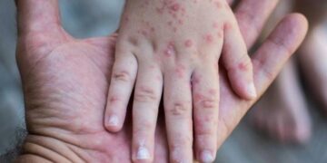 Reportan 7 casos confirmados de sarampión en México