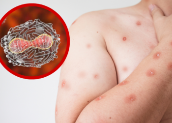 SST confirma primer caso de viruela símica