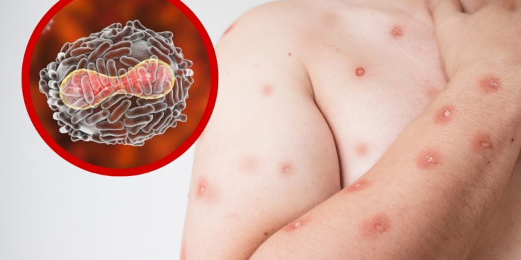 SST confirma primer caso de viruela símica