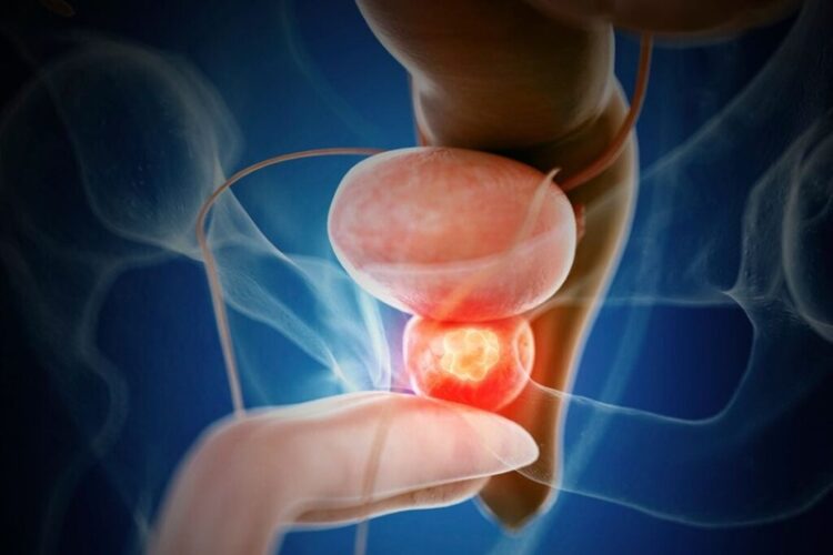 11 de junio, ‘Día Mundial del Cáncer de Próstata’