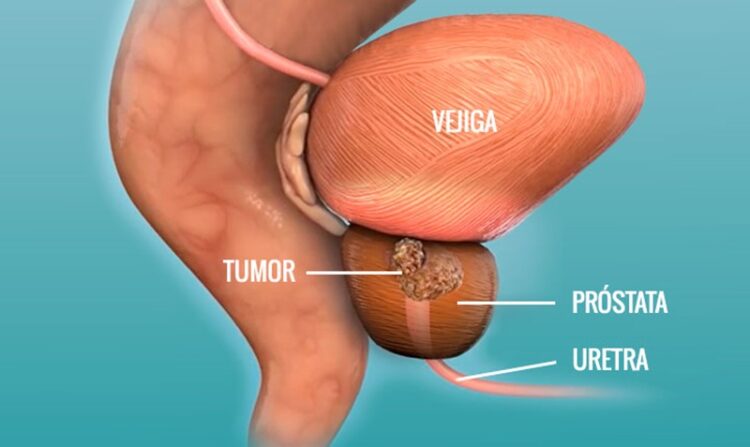 11 de junio, ‘Día Mundial del Cáncer de Próstata’