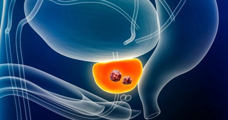 11 de junio, ‘Día Mundial del Cáncer de Próstata’